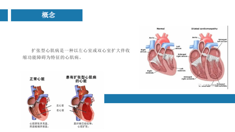 扩张性心肌病最新进展